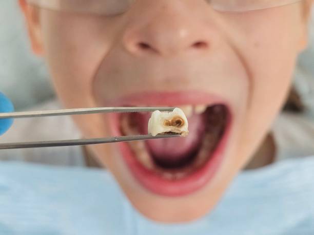 Best Emergency Dental Care for Broken or Chipped Teeth in Middleburg Heights, OH